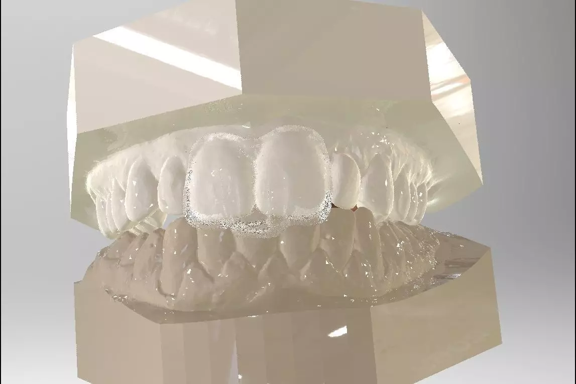 Digital Dental NTI Splint  3D print model_0