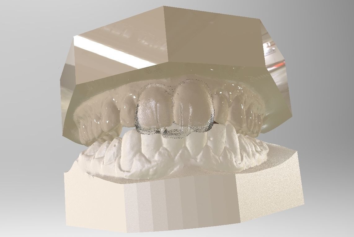 Digital Dental NTI Splint  3D print model_6