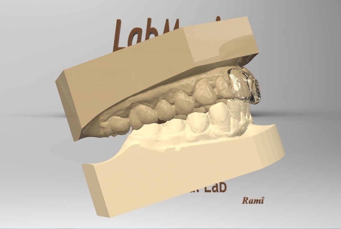 Digital Dental NTI Splint  3D print model_7