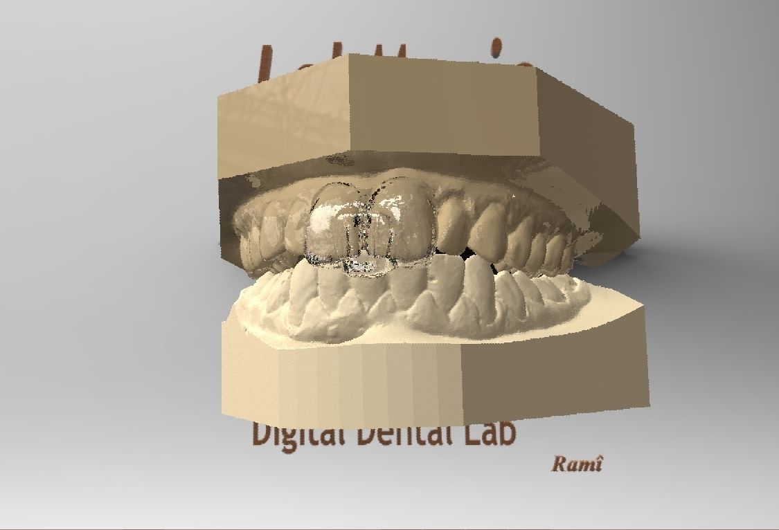 Digital Dental NTI Splint  3D print model_9