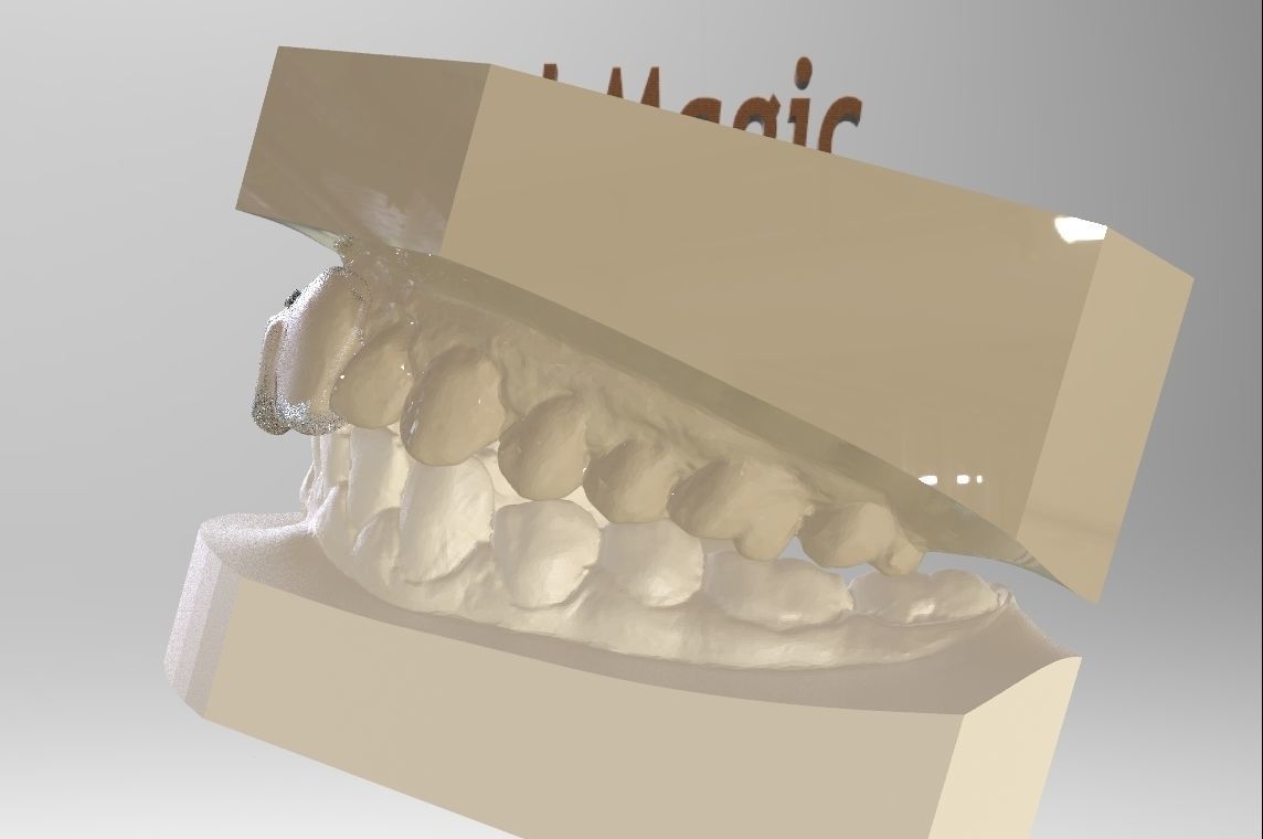 Digital Dental NTI Splint  3D print model_10