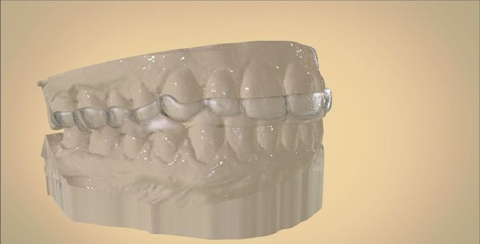 Digital Dental Bite Splint 3D print model