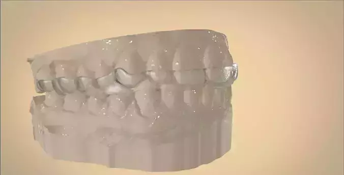 Digital Dental Bite Splint 3D print model