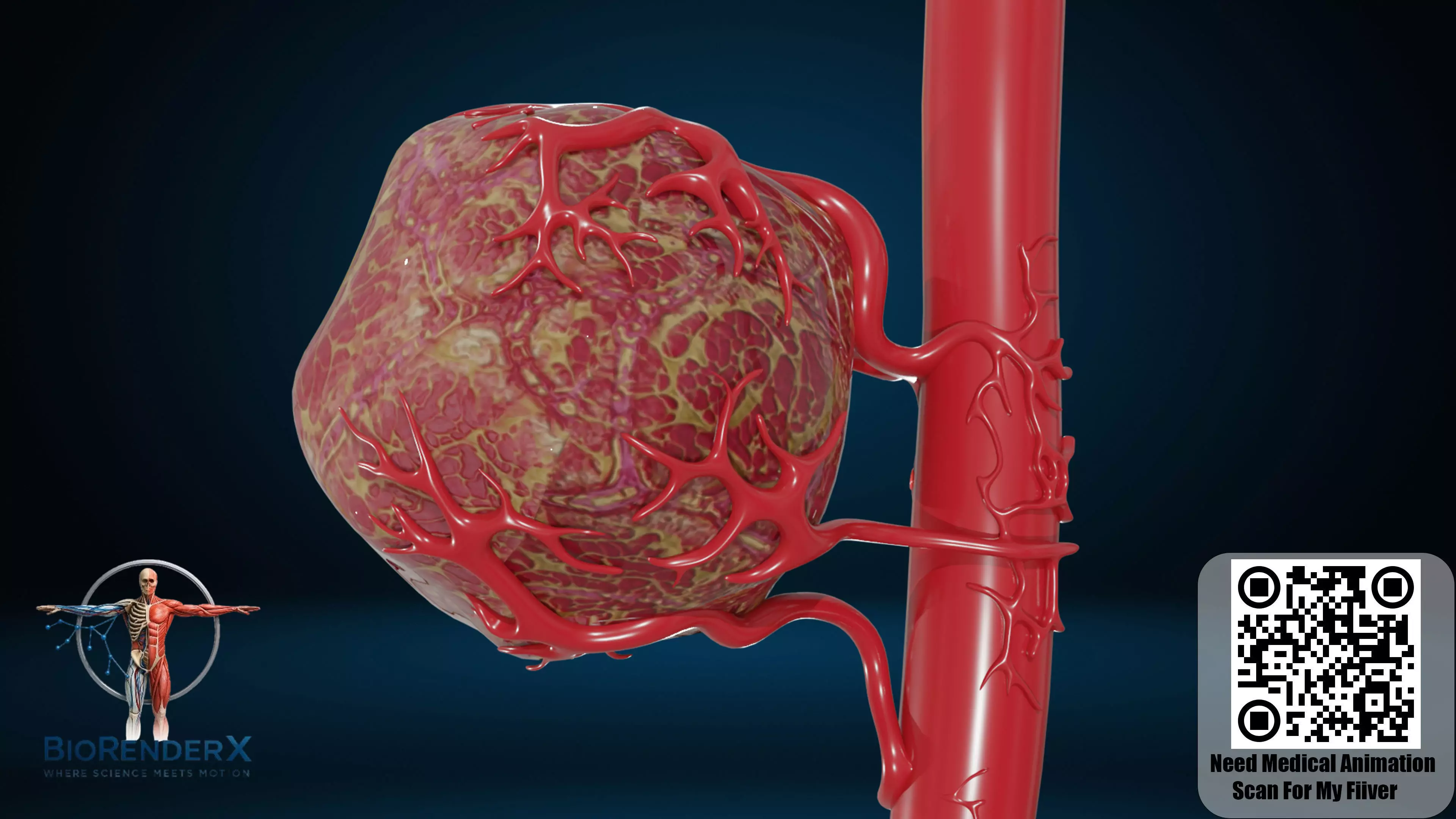 Cancer Tumor with Blood Vessels Medical 3D Model Low-poly 3D model