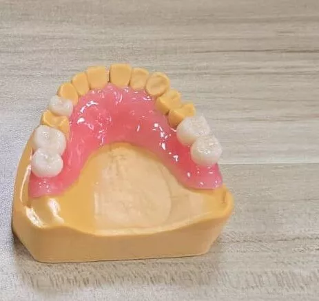Partial Denture mechanical retention 3D print model