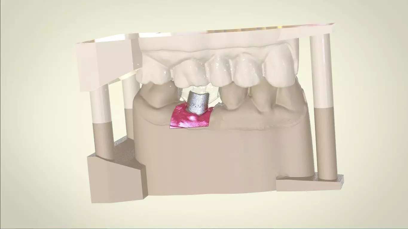 Digital Dental Implant Model with Positioning Guide 3D print model
