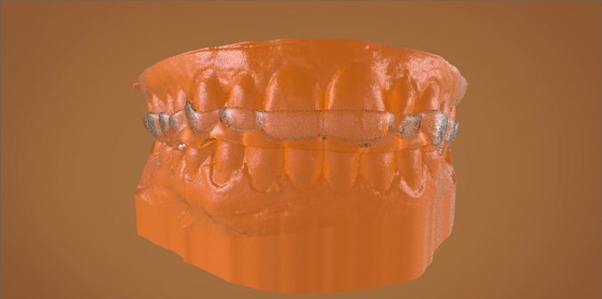 Digital Bite Raising Splint 3D print model