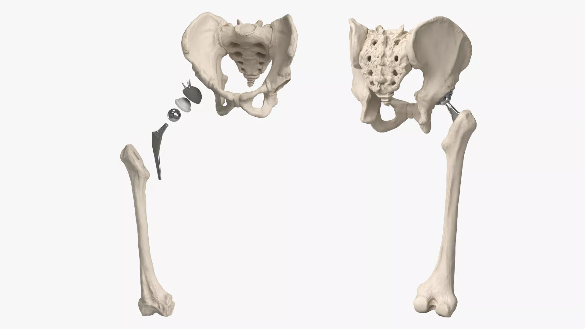 Hip Joint Implant with Pelvic Bone and Femur 3D model