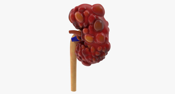 Polycystic Kidney Low-poly 3D model