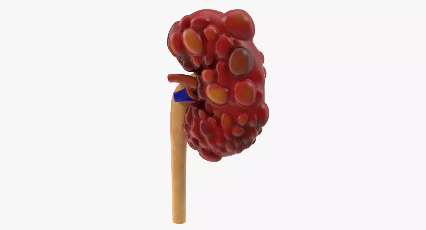 Polycystic Kidney Low-poly 3D model