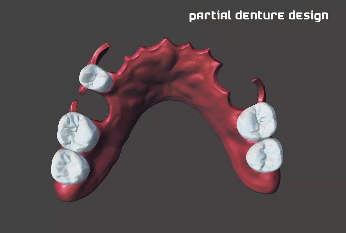 Flexible Partial Denture 3D print model