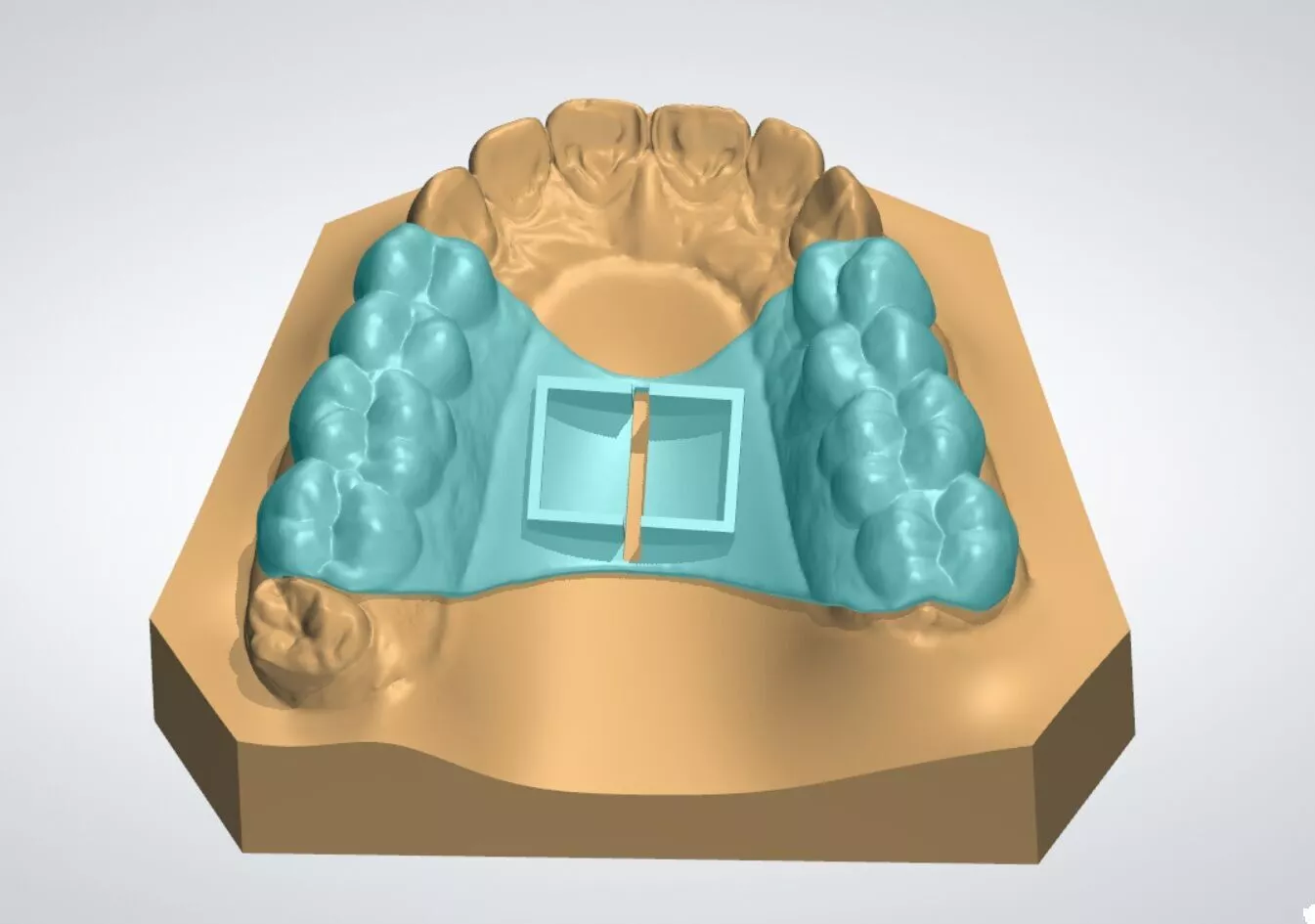 Experimental 3D-Printed Dental Expander 3D print model