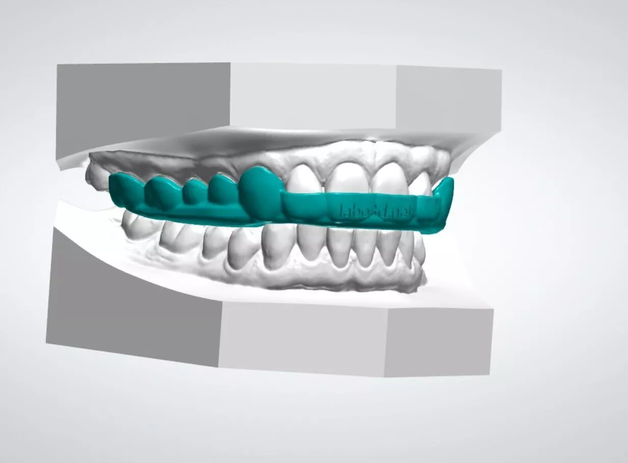 Occlusal Splint-Night guard 3D print model