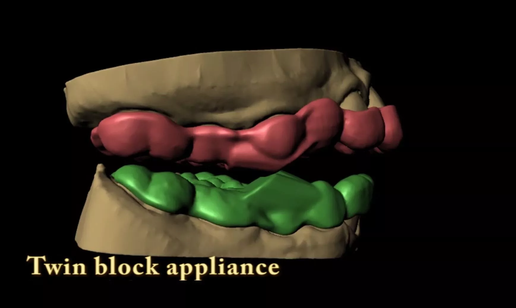Twin-Block Appliance 3D print model