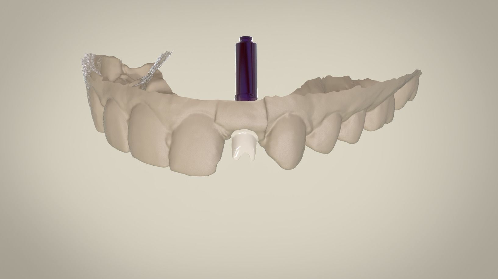 Digital Custom Dental Abutment 3D print model