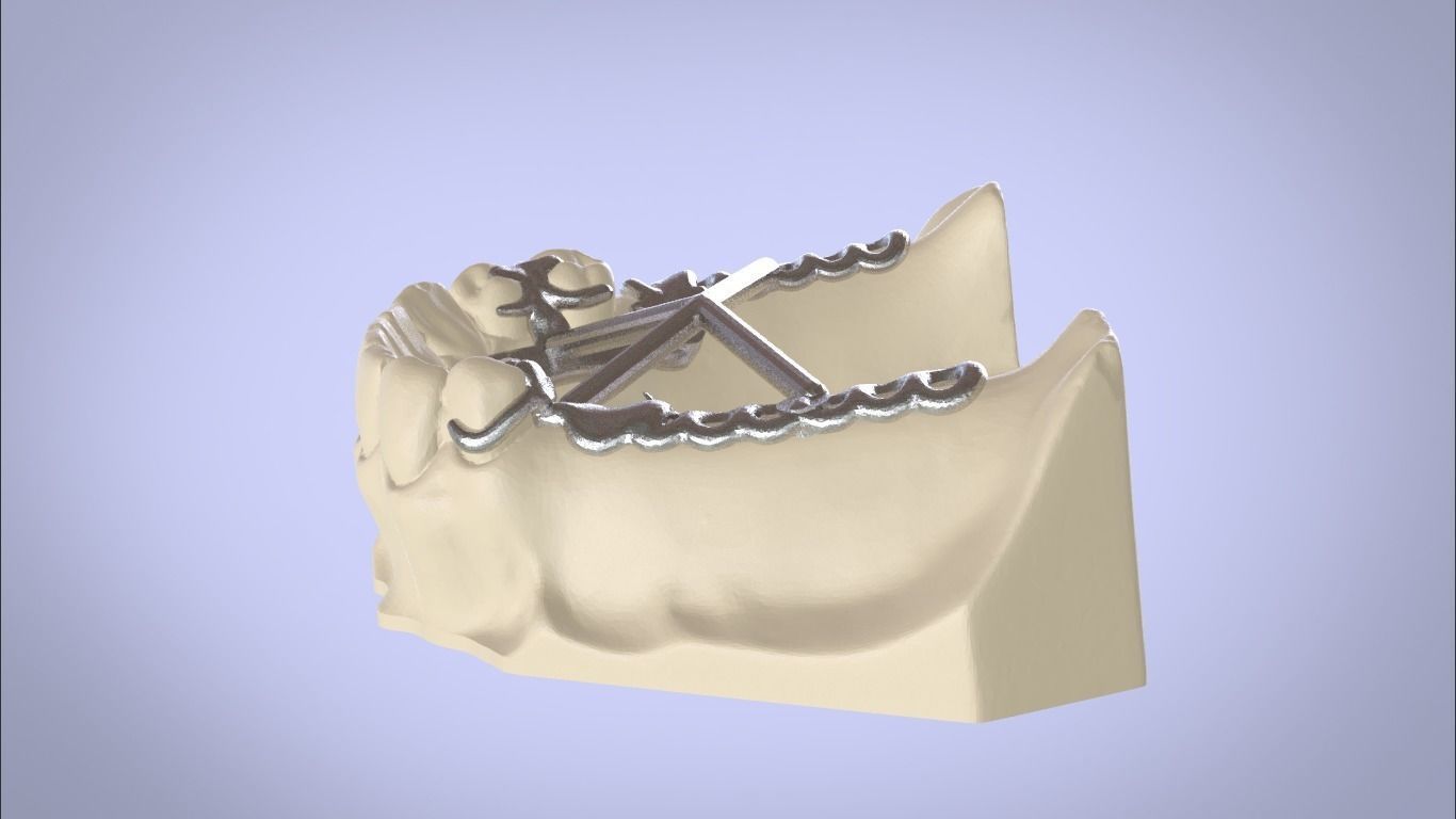 RPD Framework for SLM CNC and 3D Printing 3D print model_3