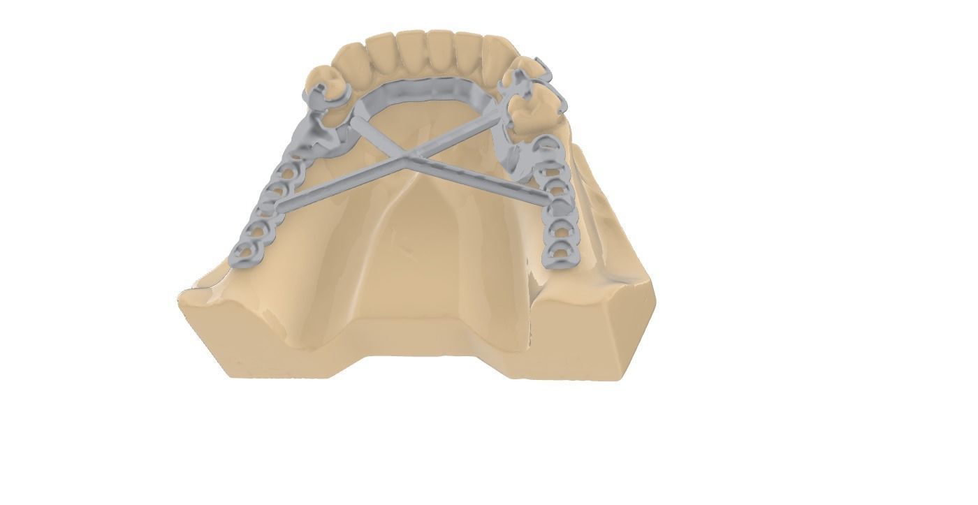 RPD Framework for SLM CNC and 3D Printing 3D print model_16
