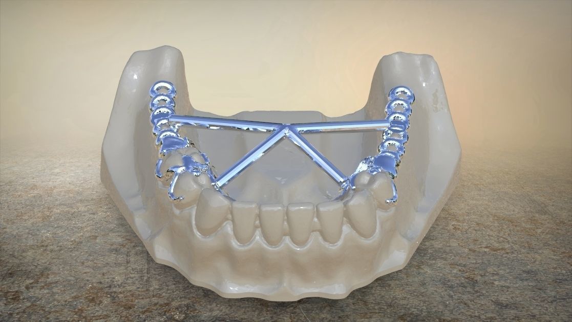 RPD Framework for SLM CNC and 3D Printing 3D print model_5