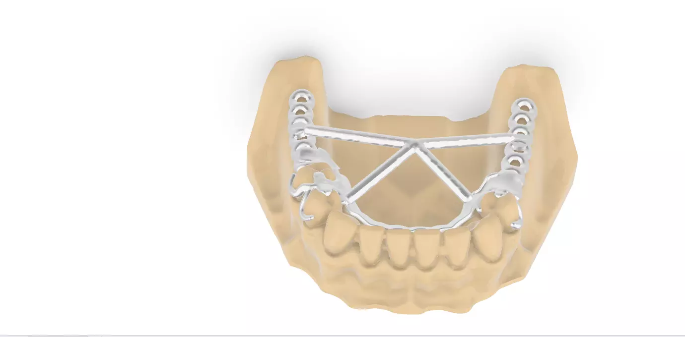 RPD Framework for SLM CNC and 3D Printing 3D print model_0