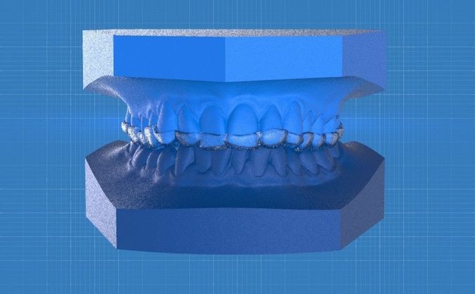 Ortho Anterior Repositioning Splint 3D print model
