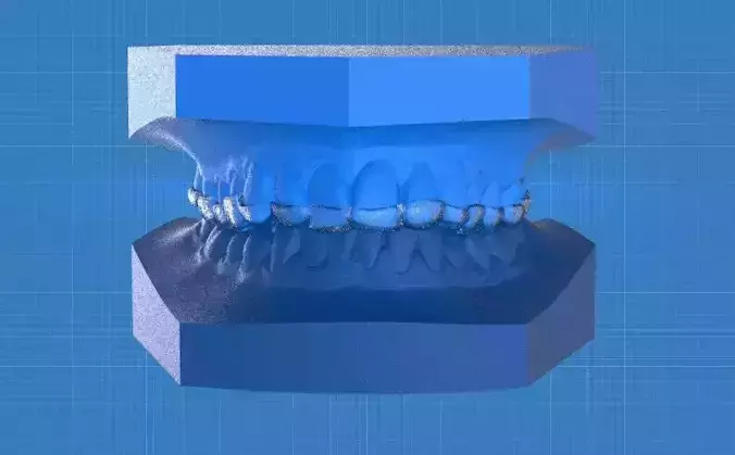 Ortho Anterior Repositioning Splint 3D print model