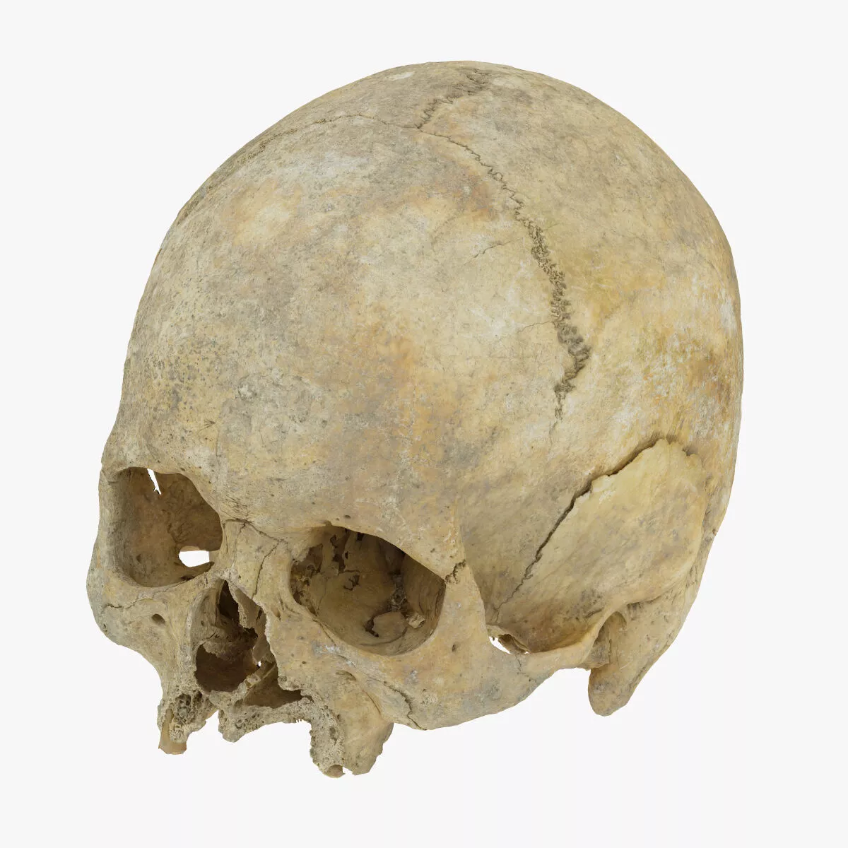 Real Human Skull Cranium with Leprosy 01 RAW SCAN 3D model