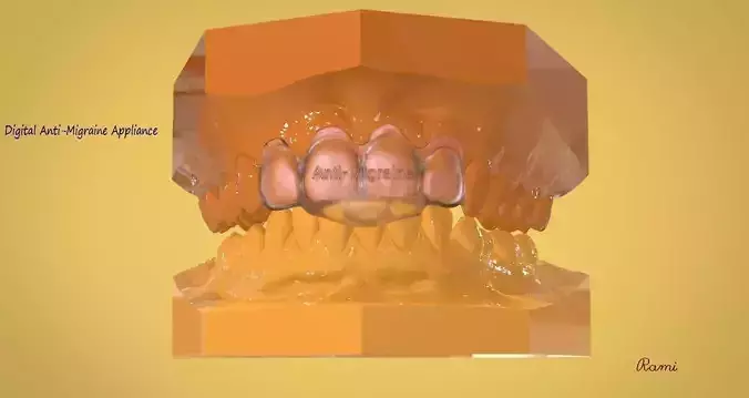 Digital Anti-Migraine Appliance 3D print model