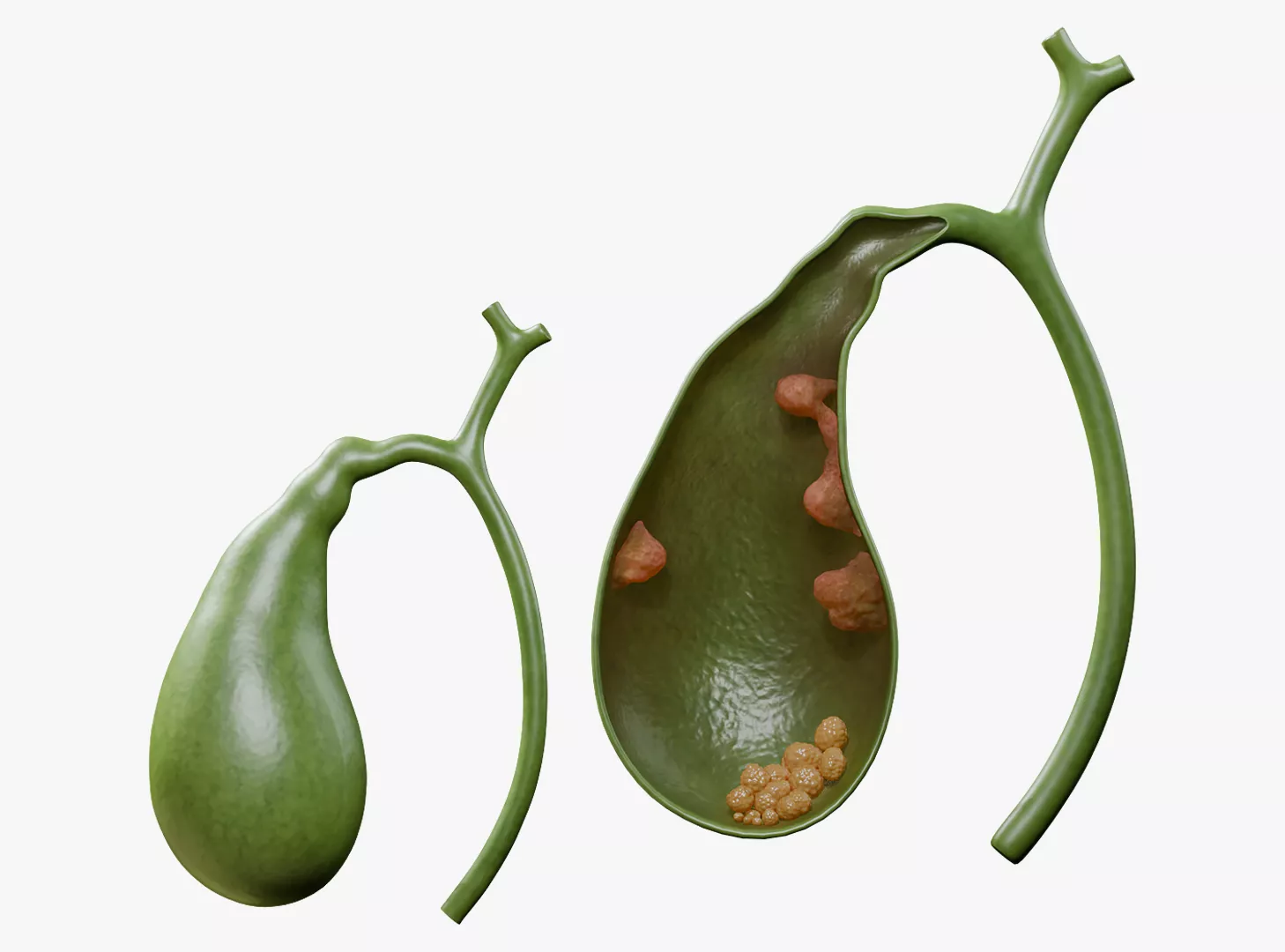 Human Gallbladder with Gallstones and Polyps Anatomy 3D model
