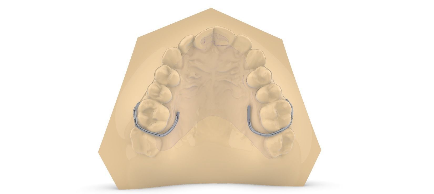 Digital DTI Deprogrammer Appliance 3D print model_2