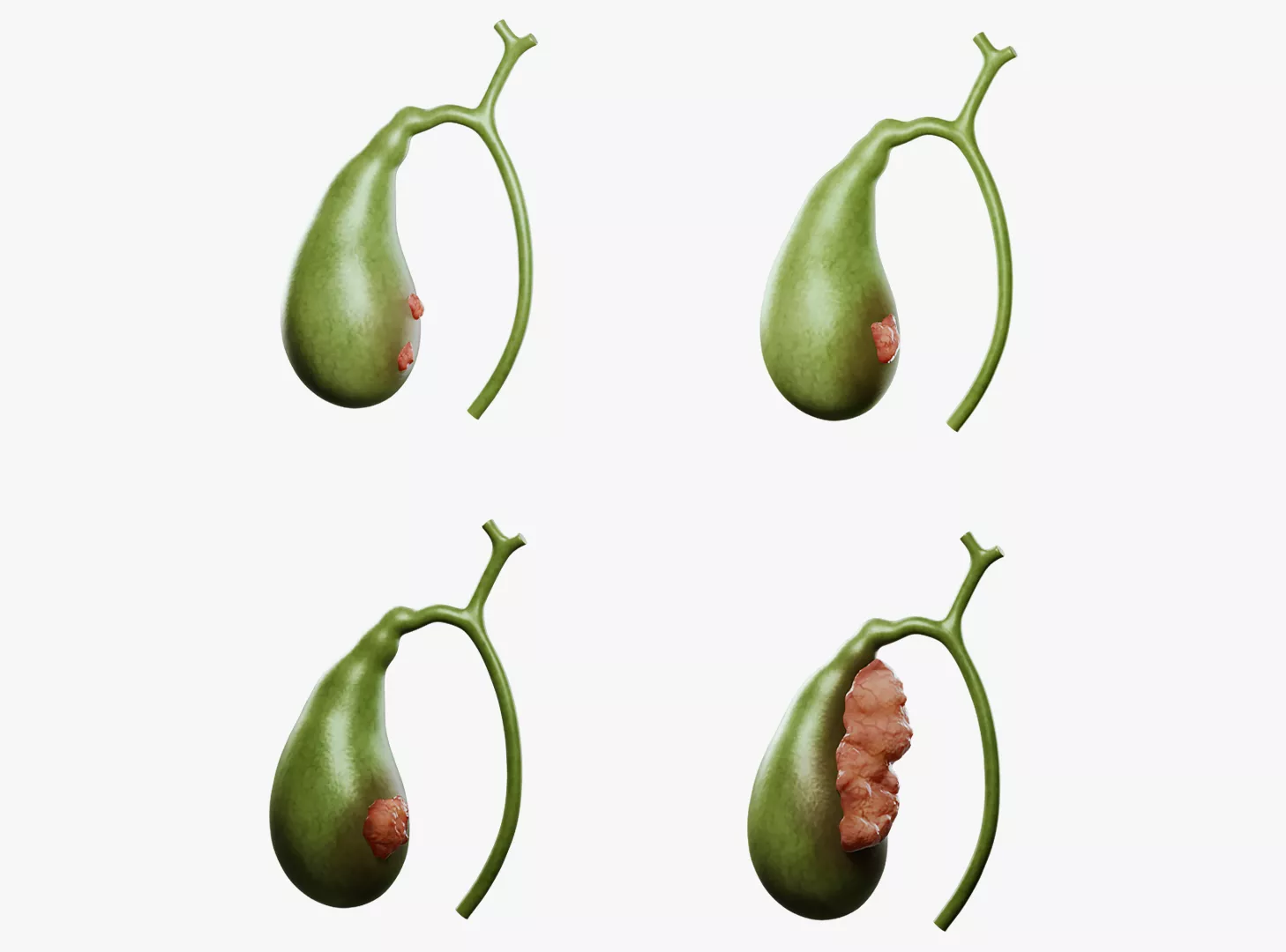 Gallbladder Cancer Progression Stages Anatomy 3D model
