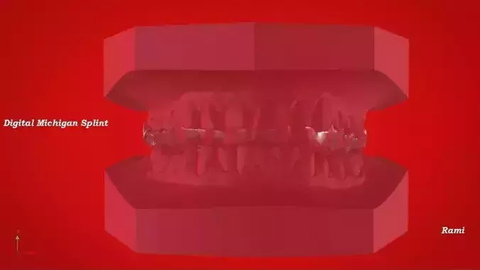 Digital Michigan Splint for 3D Printing 3D print model