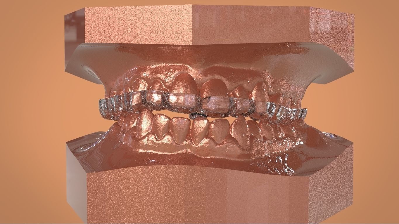 Digital KOIS Style Nightguard 3D print model_12