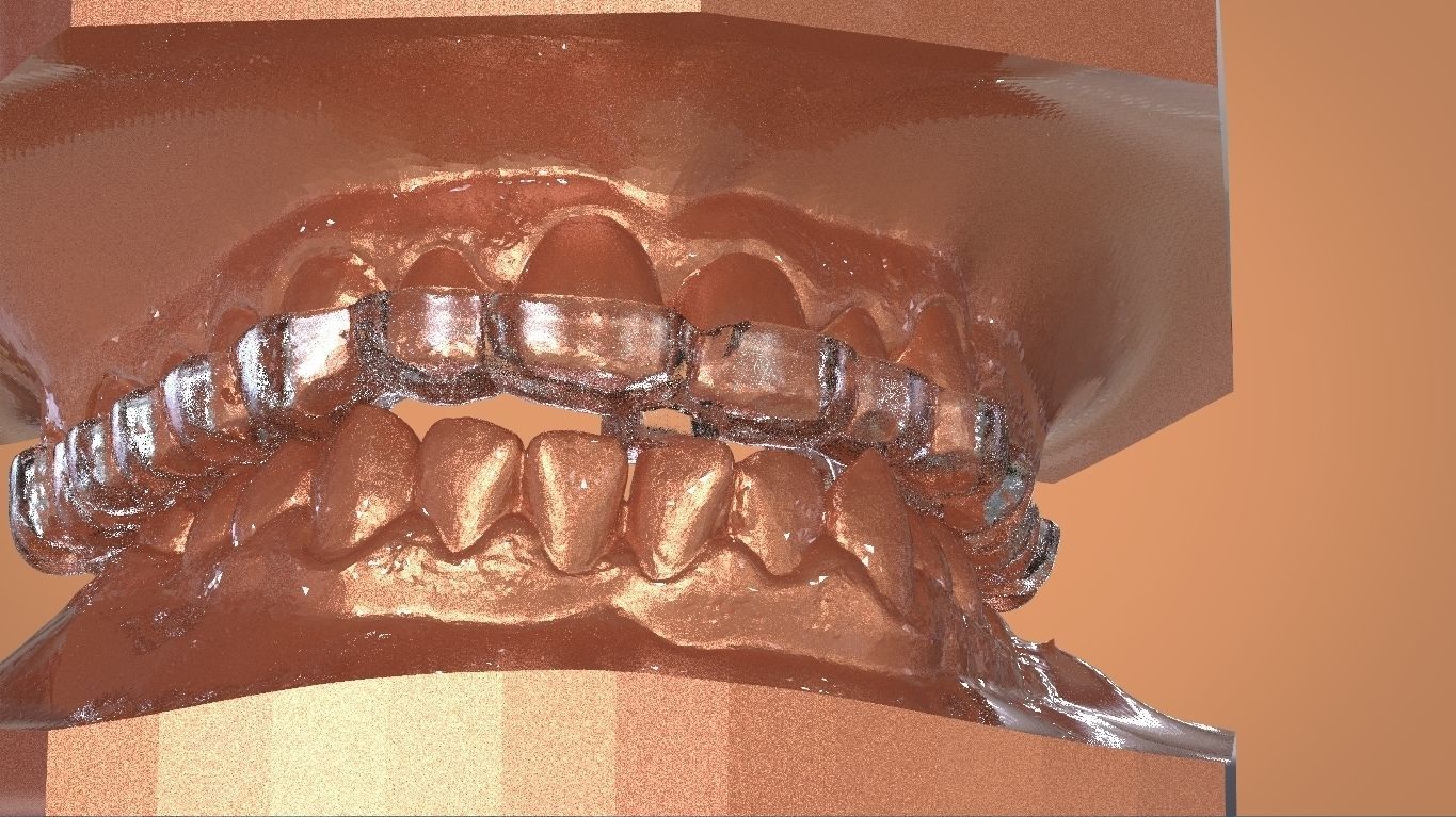 Digital KOIS Style Nightguard 3D print model_18