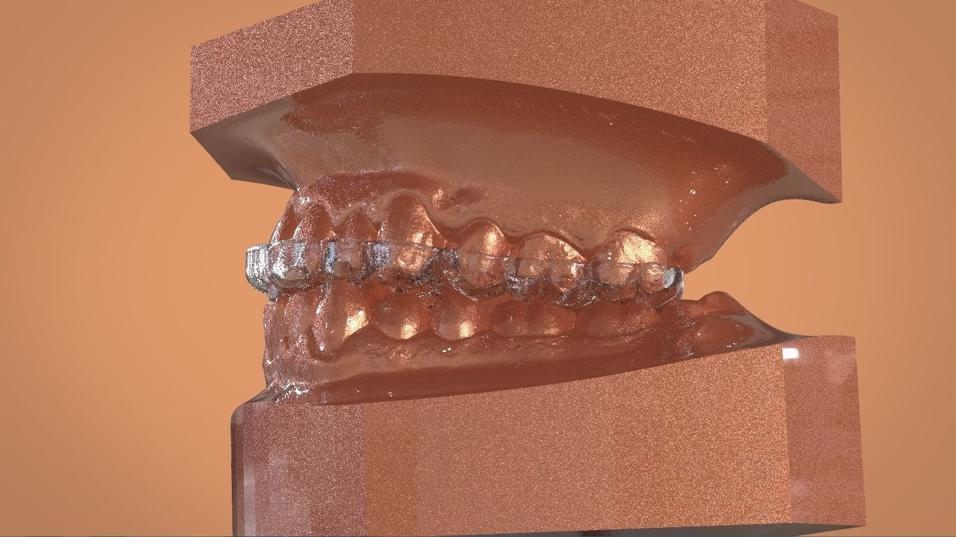 Digital KOIS Style Nightguard 3D print model_10