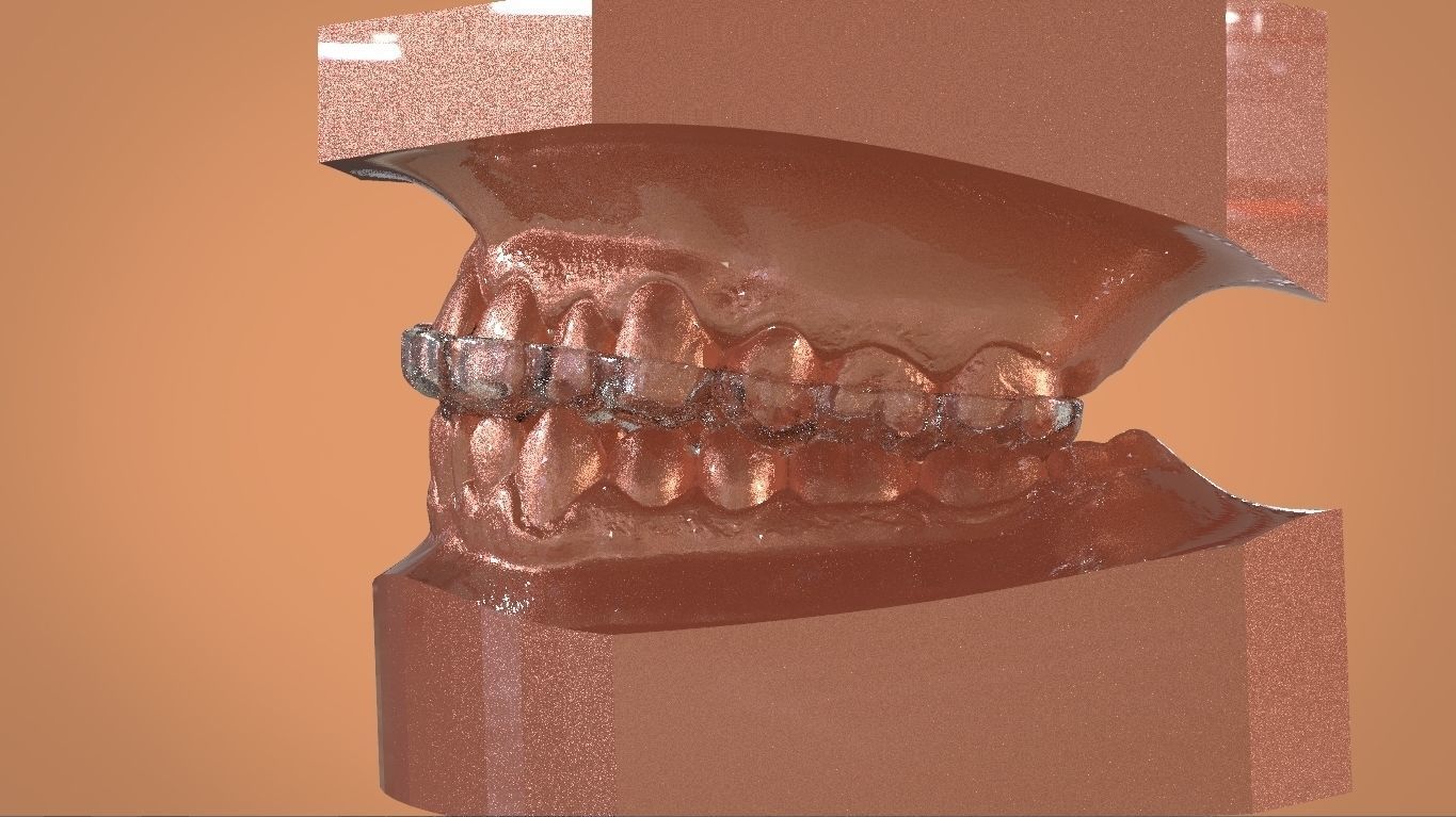 Digital KOIS Style Nightguard 3D print model_8