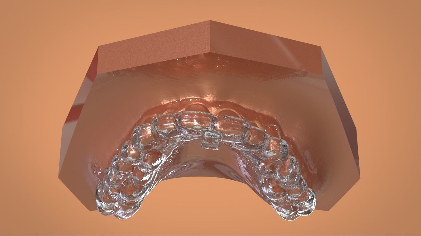 Digital KOIS Style Nightguard 3D print model_11