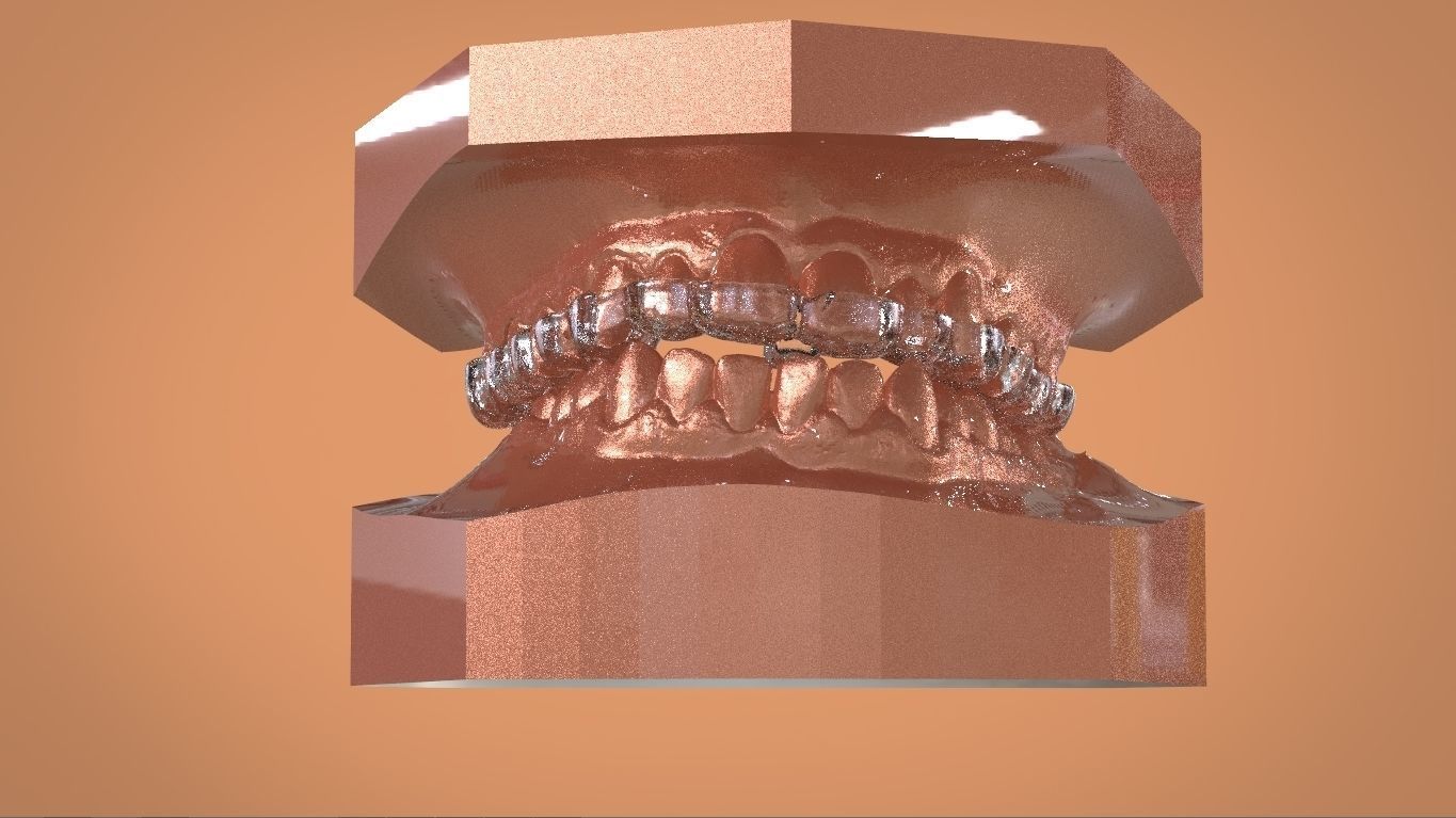 Digital KOIS Style Nightguard 3D print model_1