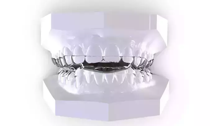 Digital Dental B Splints