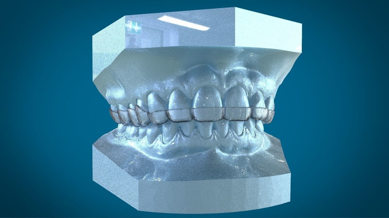 Digital Dayguard Splint 3D print model_5