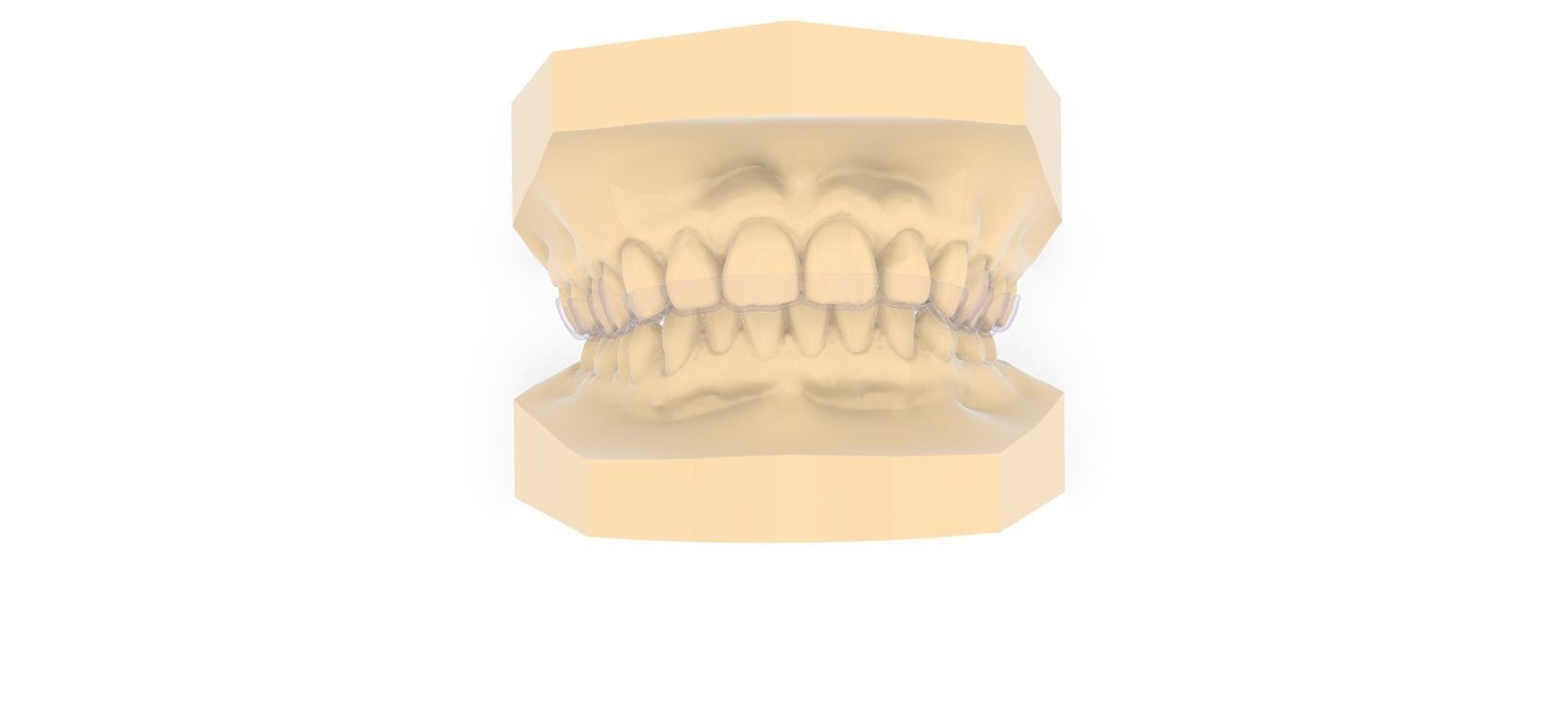 Digital Dayguard Splint 3D print model_4