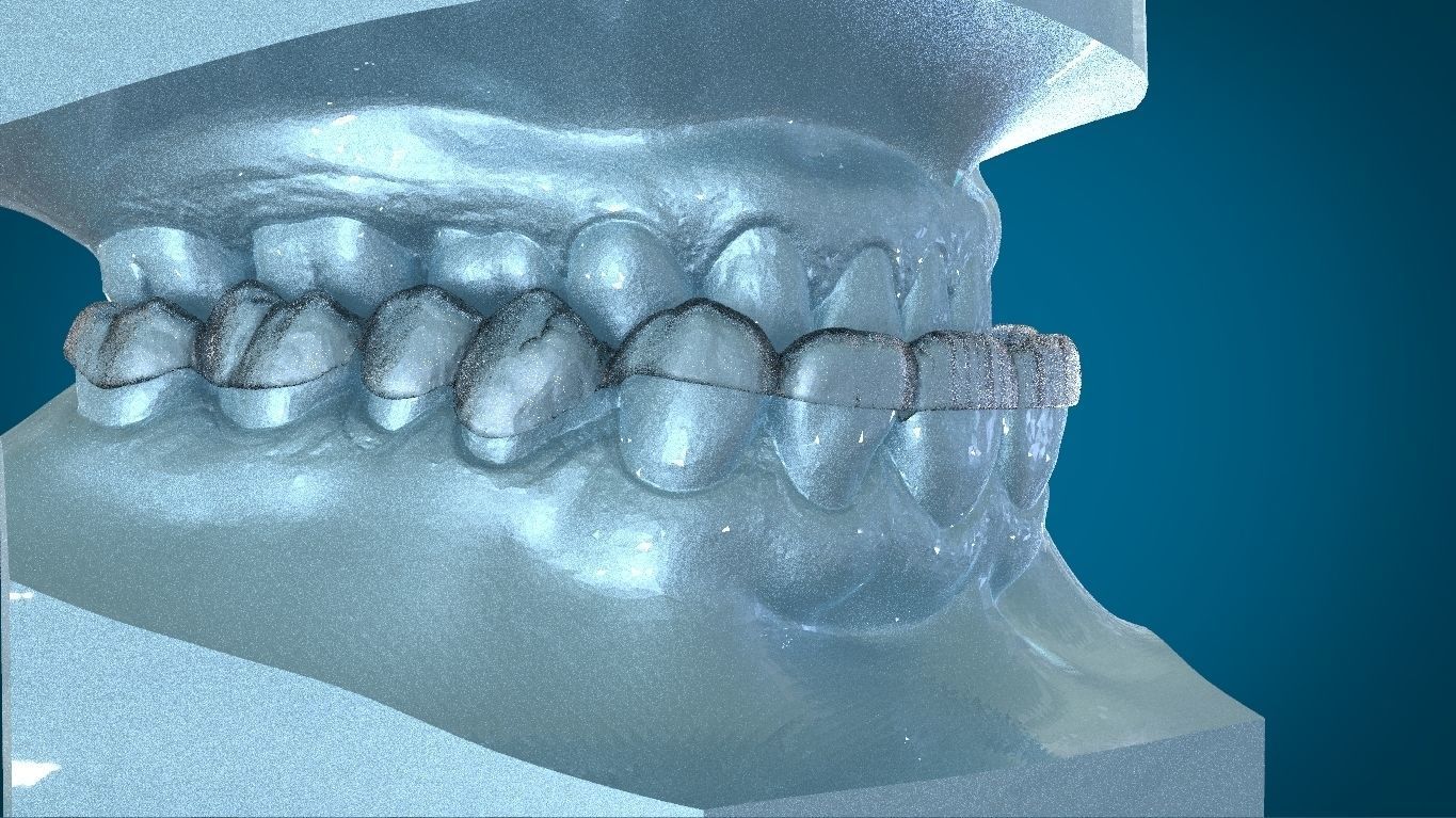 Digital Dayguard Splint 3D print model_12