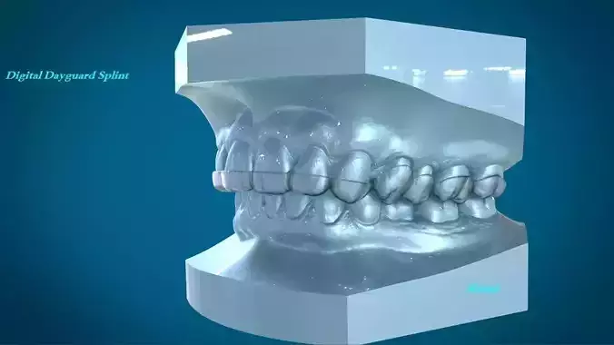 Digital Dayguard Splint 3D print model