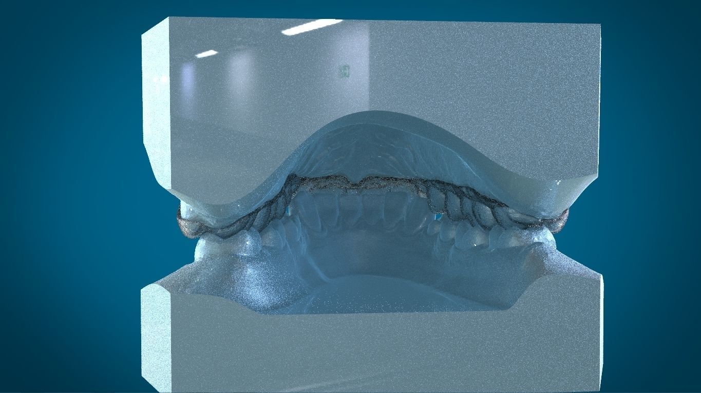 Digital Dayguard Splint 3D print model_10