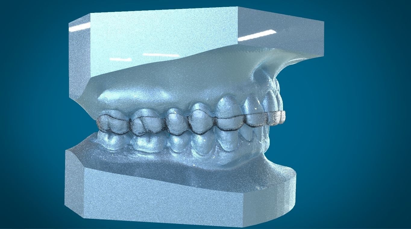 Digital Dayguard Splint 3D print model_8