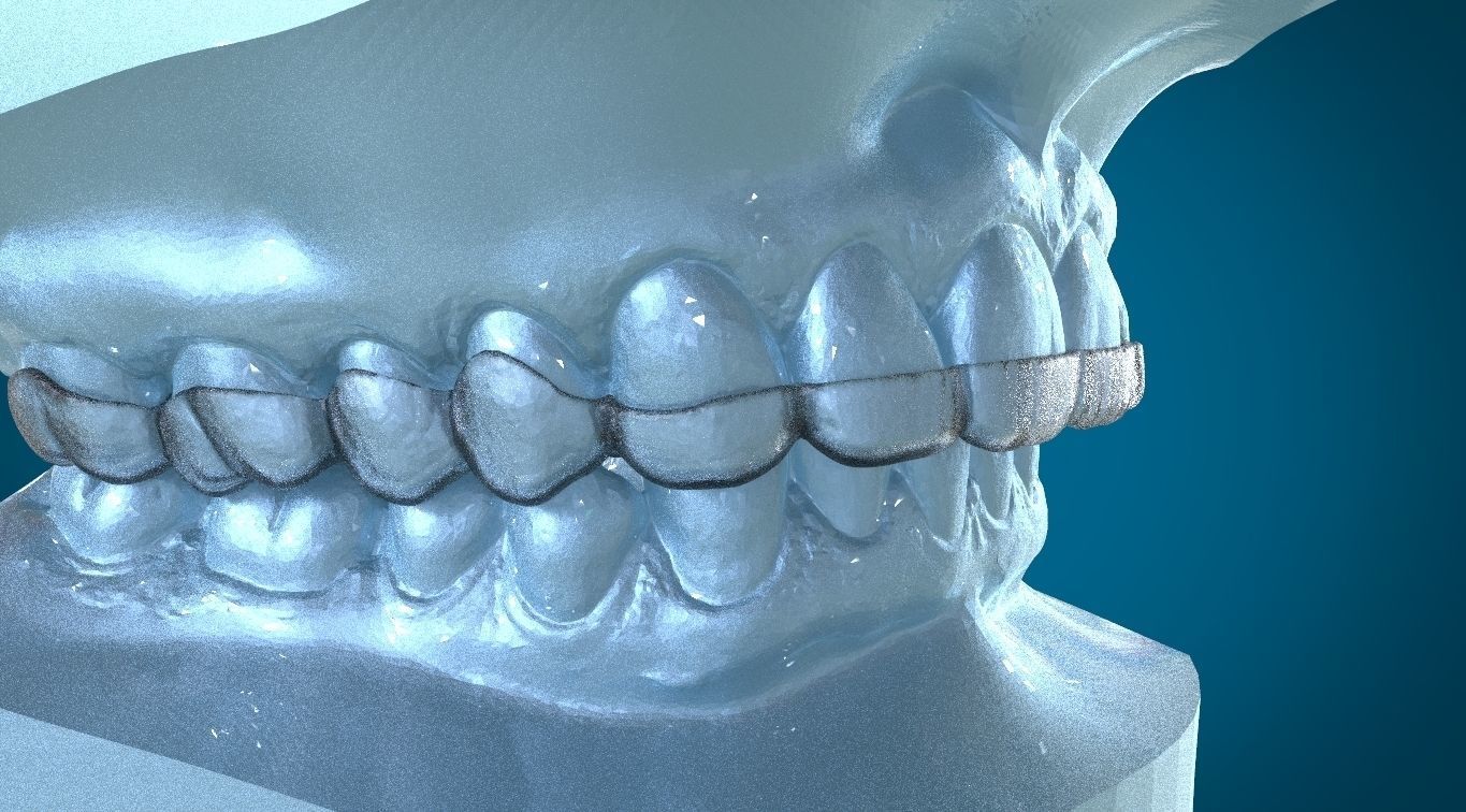 Digital Dayguard Splint 3D print model_13