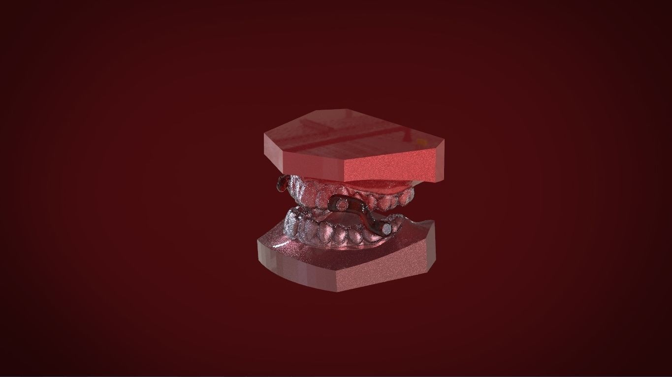 Digital Sleep Apnea Mouthguard 3D print model_15