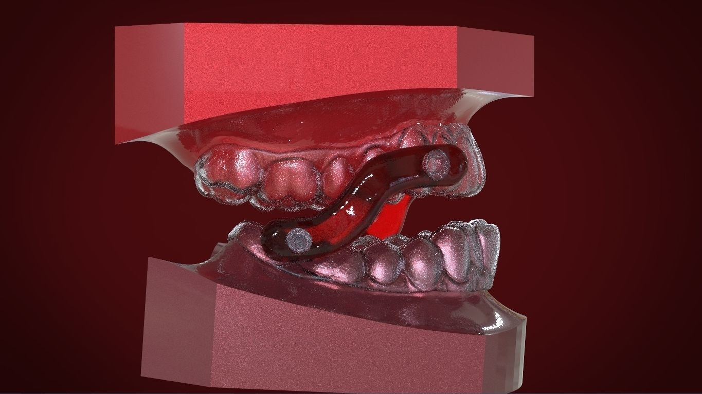 Digital Sleep Apnea Mouthguard 3D print model_2
