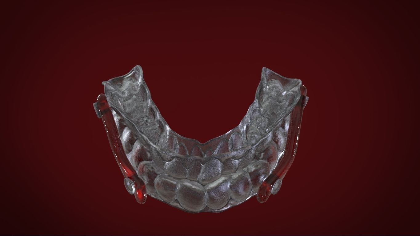 Digital Sleep Apnea Mouthguard 3D print model_12