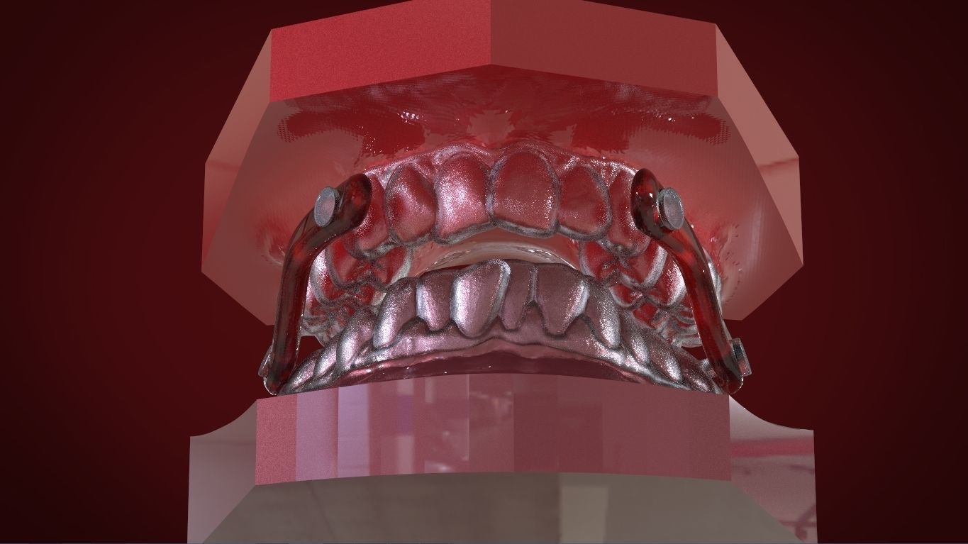 Digital Sleep Apnea Mouthguard 3D print model_14