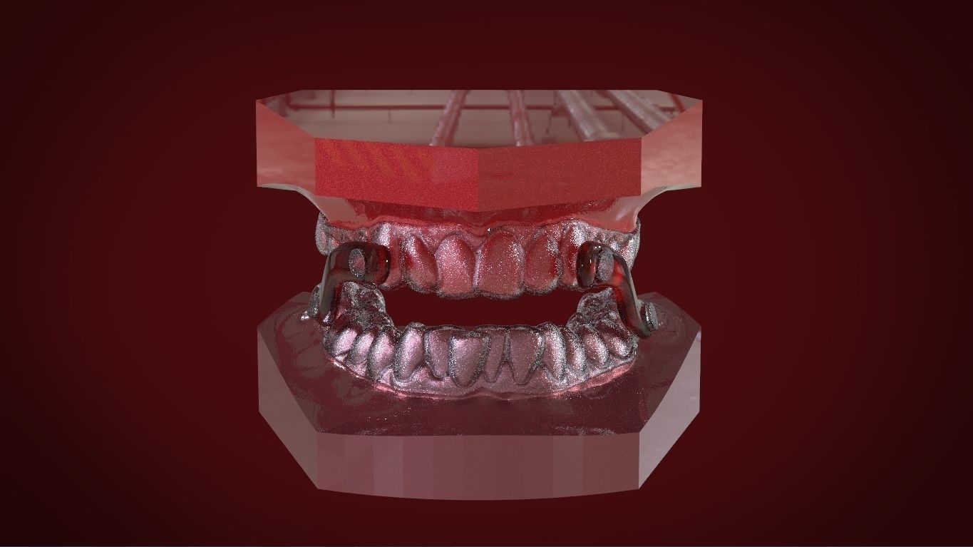 Digital Sleep Apnea Mouthguard 3D print model_7